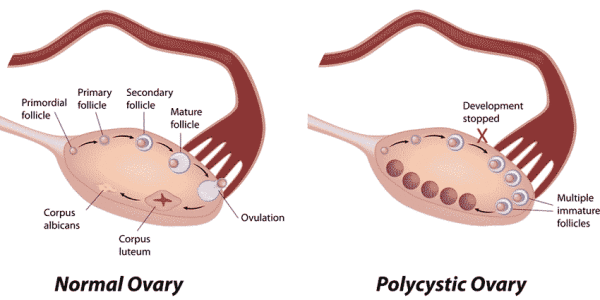 Perfect Diagnosis and Treatment to cure Ovarian Cysts