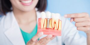 Why choose a good dentist to do a dental implant?