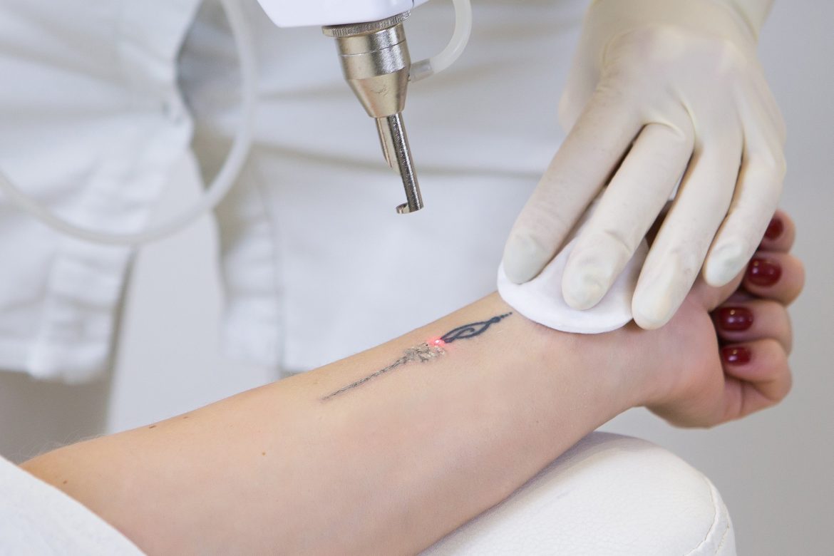Facts And Myths About Tattoo Removal